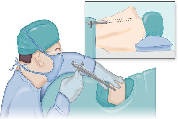 Medical Thoracoscopy