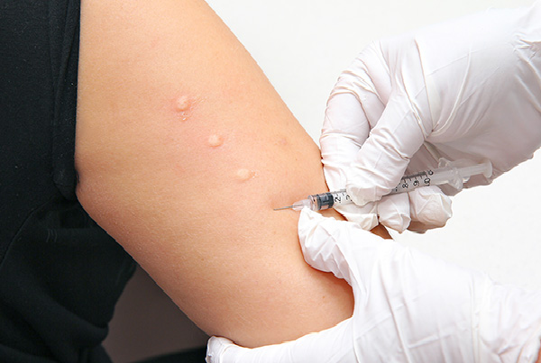 Allergy Testing