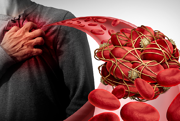 Pulmonary Thromboembolism