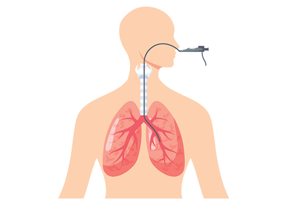 Bronchoscopy