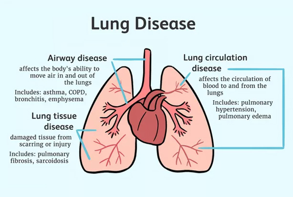 Interstitial Lung Disease